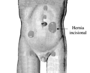 Cirugía de Hernia Incisional en Puebla