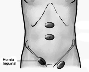 Cirugía de Hernia Inguinal en Puebla